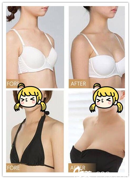 华美医院刘涛胸部整形效果案例