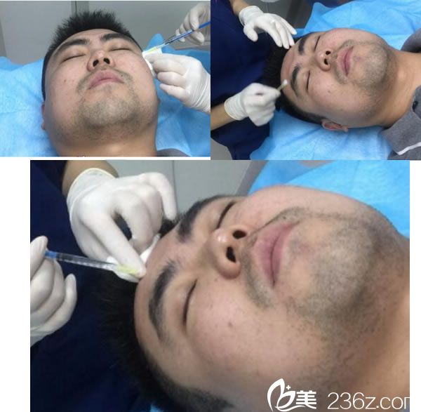 陈彩媛医生注射了瘦脸除皱过程图