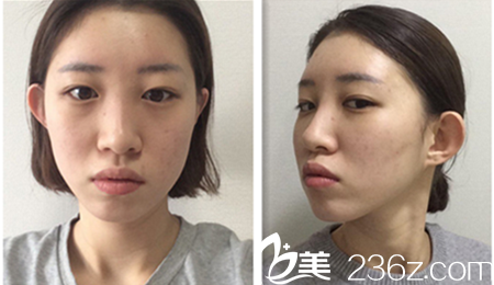韩国omega整形外科医院真人整形案例术前照 韩国omega整形外科医院真人整形案例术前照