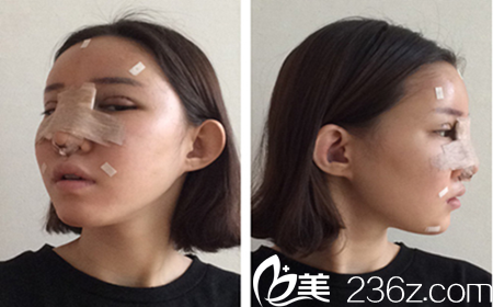 韩国Omega整形外科医院真人案例手术当天照 韩国Omega整形外科医院真人案例手术当天照