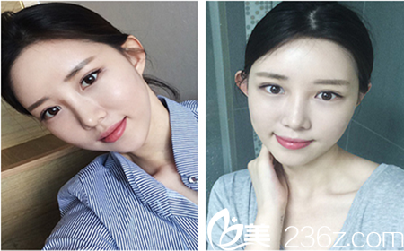 韩国Omega(欧米茄)整形外科真人手术案例术后三周效果 韩国Omega(欧米茄)整形外科真人手术案例术后三周效果