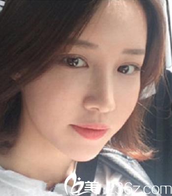 韩国Omega(欧米茄)整形外科医院真人整形案例术后两个月照 韩国Omega(欧米茄)整形外科医院真人整形案例术后两个月照