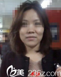 韩国431整形外科金载勋院长隆鼻怎么样？真人案例