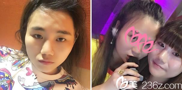 做手术前的塌鼻子和单眼皮 做手术前的塌鼻子和单眼皮