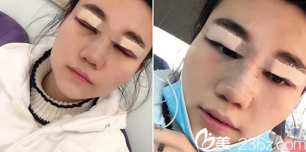 做完眼睛和鼻子手术当天 做完眼睛和鼻子手术当天