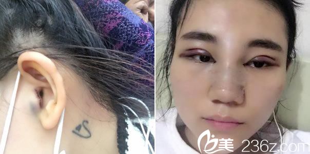 耳软骨隆鼻手术第2天恢复照 耳软骨隆鼻手术第2天恢复照