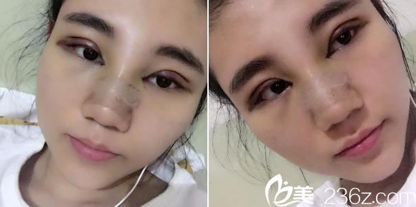 做双眼皮开眼角手术第3天 做双眼皮开眼角手术第3天