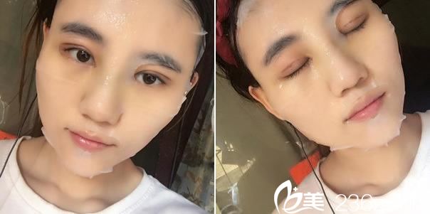 做双眼皮手术第9天敷面膜照片 做双眼皮手术第9天敷面膜照片