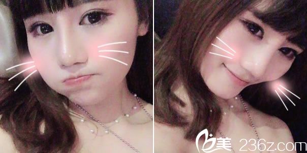 双眼皮和隆鼻手术1个月恢复照 双眼皮和隆鼻手术1个月恢复照