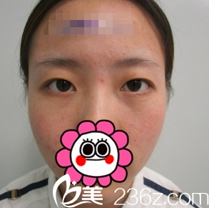 长治悦美双眼皮整形术前 长治悦美双眼皮整形术前