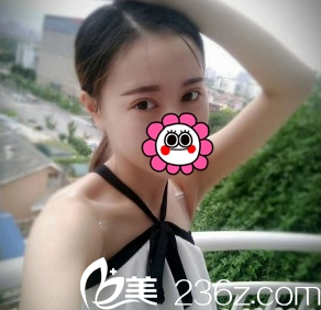 长治悦美双眼皮术后1天效果 长治悦美双眼皮术后1天效果