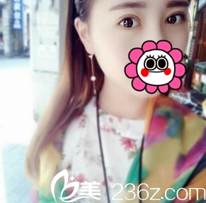 真人案例双眼皮术后15天长治悦美整形 真人案例双眼皮术后15天长治悦美整形