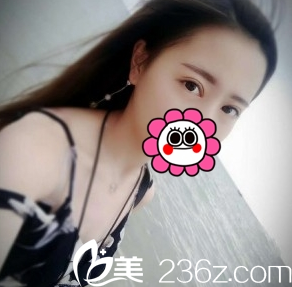 双眼皮恢复日记组图：长治悦美整形1周让我有无痕美眼效果