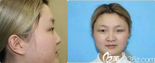 假体隆鼻术前塌鼻子 假体隆鼻术前塌鼻子