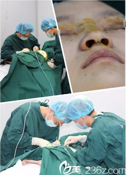 徐佳明院长隆鼻手术过程中 徐佳明院长隆鼻手术过程中