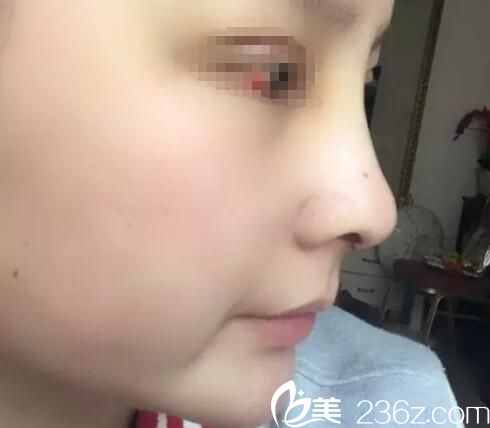 隆鼻后七天拆线效果 隆鼻后七天拆线效果