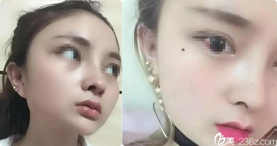 找镇江苏王徐佳明院长6500元够做假体隆鼻吗?案例效果怎么样