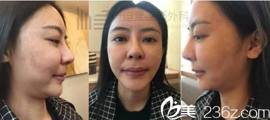 韩国美迪莹整形真人案例1 韩国美迪莹整形真人案例1