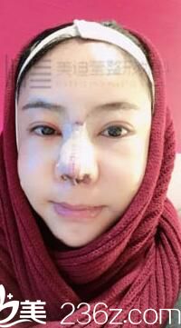 韩国美迪莹整形真人案例3 韩国美迪莹整形真人案例3