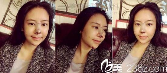 韩国美迪莹整形真人案例4 韩国美迪莹整形真人案例4