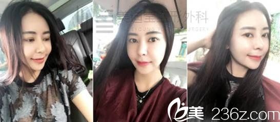 分享我在韩国美迪莹徐范信做面部吸脂+埋线提升+取颊脂垫+下巴肌肉捆绑塑形+鼻子整形