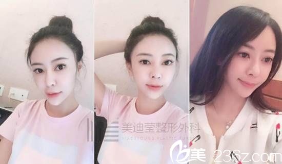韩国美迪莹整形真人案例6 韩国美迪莹整形真人案例6