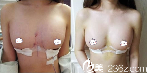 韩国高兰得假体隆胸术后一天 韩国高兰得假体隆胸术后一天