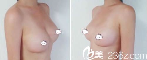 韩国高兰得整容外科假体隆胸两个月后 韩国高兰得整容外科假体隆胸两个月后