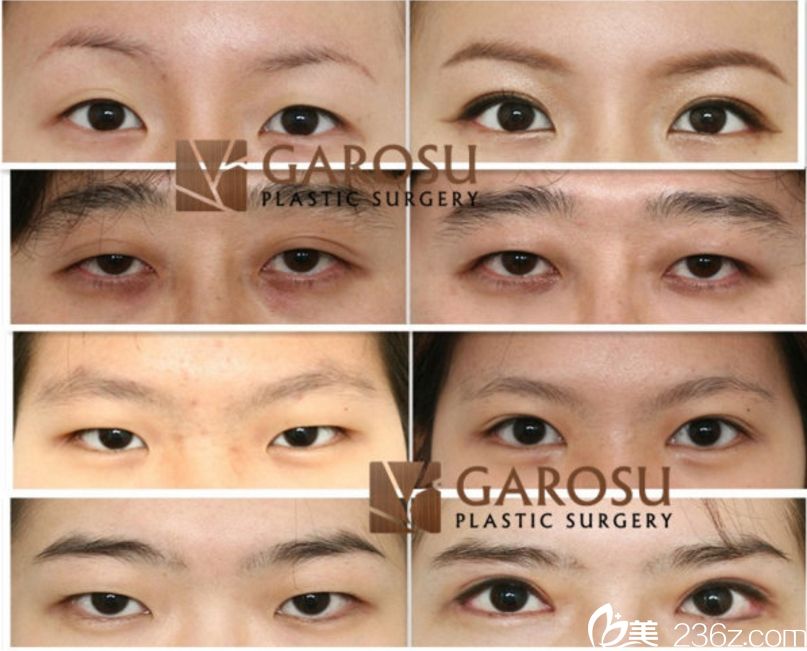 朴章佑做眼部整的精彩案例 朴章佑做眼部整的精彩案例