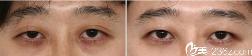 韩国凯伦秀整形医院术前照片1