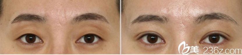 凯伦秀整形外科做眼部整形怎么样 凯伦秀整形外科做眼部整形怎么样