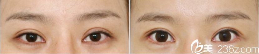 韩国凯伦秀整形外科非切开双眼皮真人案例