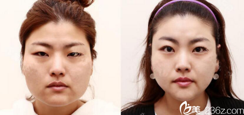 凯伦秀 非切开埋线提肌+颧骨+V脸+脸部吸脂真人案例 凯伦秀 非切开埋线提肌+颧骨+V脸+脸部吸脂真人案例