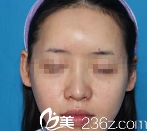 崔钟武院长膨体隆鼻真人案例手术前 崔钟武院长膨体隆鼻真人案例手术前