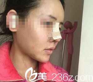 崔钟武院长膨体隆鼻刚做完手术当天 崔钟武院长膨体隆鼻刚做完手术当天