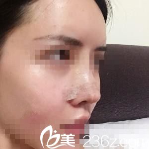 崔钟武院长膨体隆鼻三天后 崔钟武院长膨体隆鼻三天后