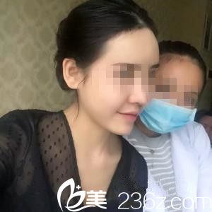 崔钟武院长膨体隆鼻7天后 崔钟武院长膨体隆鼻7天后