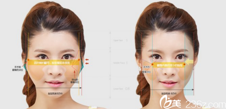 郑宰永院长颧骨手术-后端颧骨缩小术 郑宰永院长颧骨手术-后端颧骨缩小术