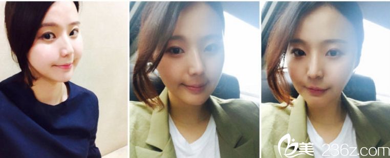 找韩国拉菲安郑宰永院长做的颧骨缩小+vline 让我变得美丽自信