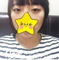 厦门欧菲双眼皮整形前 厦门欧菲双眼皮整形前