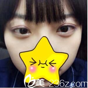 欧菲苗建国埋线双眼皮初步效果 欧菲苗建国埋线双眼皮初步效果