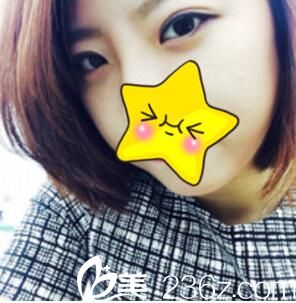 花668元找厦门欧菲苗建国做埋线双眼皮后拥有闪耀星眼