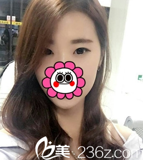 重庆艺星整形双眼皮案例术前 重庆艺星整形双眼皮案例术前