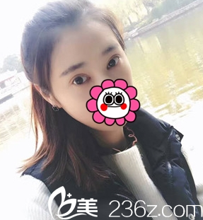 重庆艺星双眼皮整形术后7天效果 重庆艺星双眼皮整形术后7天效果