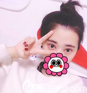 重庆艺星整形双眼皮术后1个月 重庆艺星整形双眼皮术后1个月