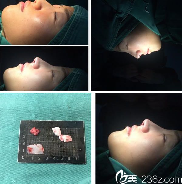 温州和平梁赞姜3D隆鼻手术过程