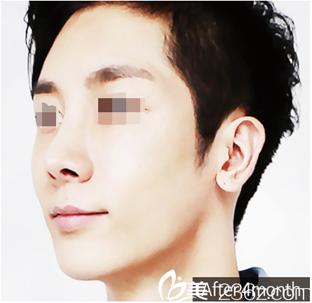 韩国优尼克鼻整形面部轮廓加自体脂肪真人整形案例，男士变美也能改变命运