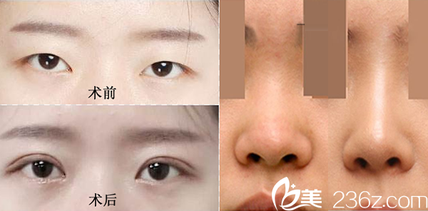 谢靖宇医生双眼皮和假体隆鼻案例图