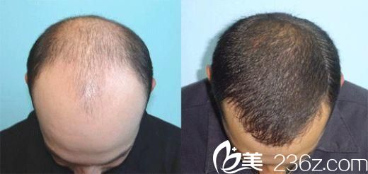 韩国狎鸥亭延世医院毛发移植