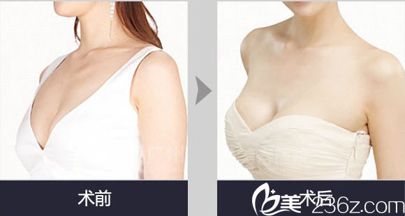 南充韩美整形自体脂肪丰胸案例 南充韩美整形自体脂肪丰胸案例